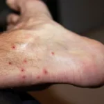 Chigger Bite Treatments