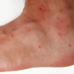 Chigger Bite Treatments