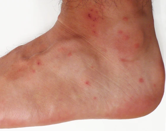 Chigger Bite Treatments