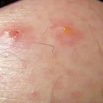 Which Chigger Bite Treatments Work For Children