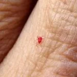 How Chigger Bite Treatments Prevent Intense Scratching