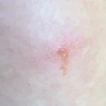 What Chigger Bite Treatments Provide For Large Bites