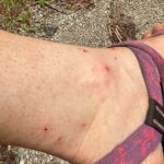 How Chigger Bite Treatments Help Reduce Irritation
