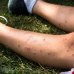 How Chigger Bite Treatments Reduce Skin Swelling