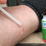 When Chigger Bite Treatments Should Be Applied