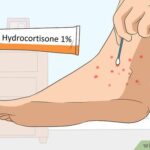 Where Chigger Bite Treatments Help The Most