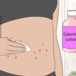 How Chigger Bite Treatments Assist Sensitive Skin