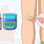 Which Chigger Bite Treatments Bring Fast Relief